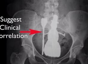rectal snowman | zdoggmd.com
