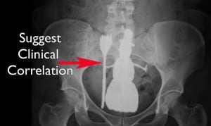 rectal snowman | zdoggmd.com